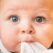 Those affected by heterochromia may have two different coloured eyes or two colours present in an eye.